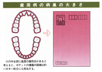 歯周病の広さ